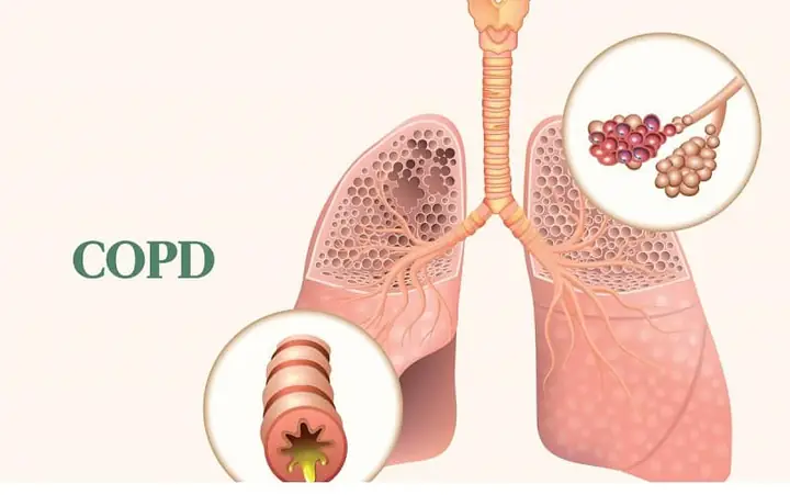 Copd Tiếng Anh Là Gì