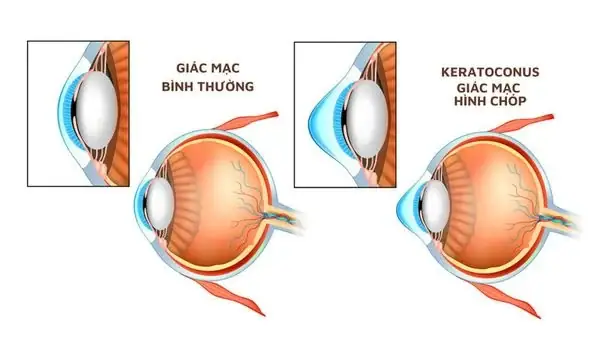 Giác Mạc Tiếng Anh Là Gì Giác Mạc Tiếng Anh Là Gì