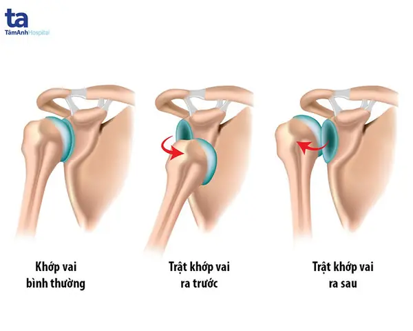 Trật Chân Tiếng Anh Là Gì