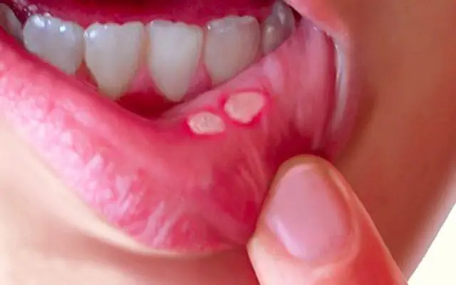 Lở Miệng Tiếng Anh Là Gì