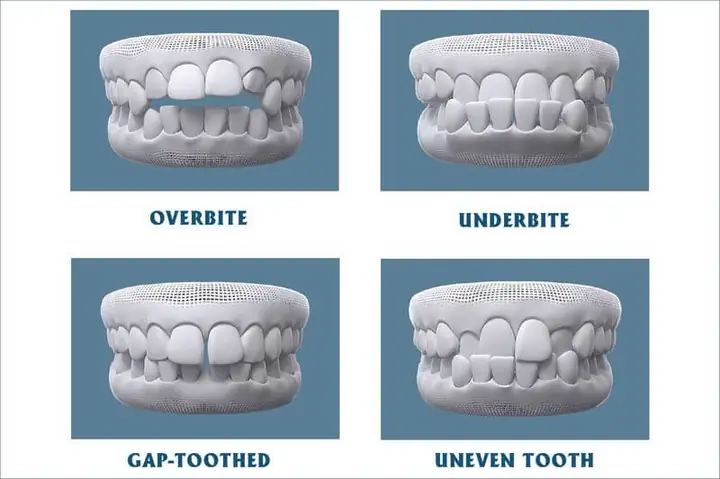 Nẹp Điện Tiếng Anh Là Gì