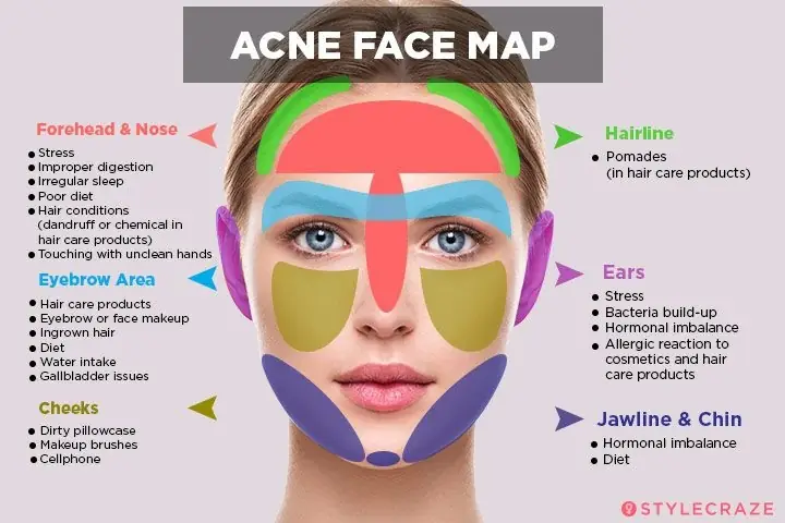 Nhân Mụn Tiếng Anh Là Gì Nhân Mụn Tiếng Anh Là Gì