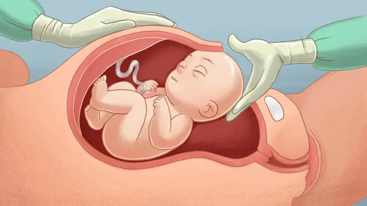 Sinh Mổ Tiếng Anh Là Gì